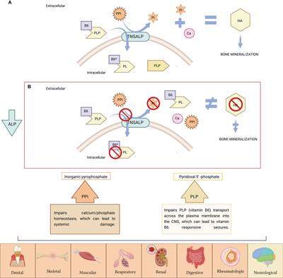 Characterization of Genetic Variants of Uncertain Significance for the ALPL Gene in Patients With Adult Hypophosphatasia